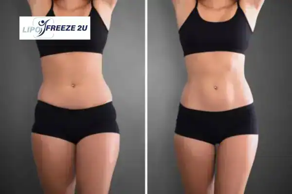 How Can LIPO FREEZE 2U Support Your Post-Pregnancy Body Recovery Bristol?