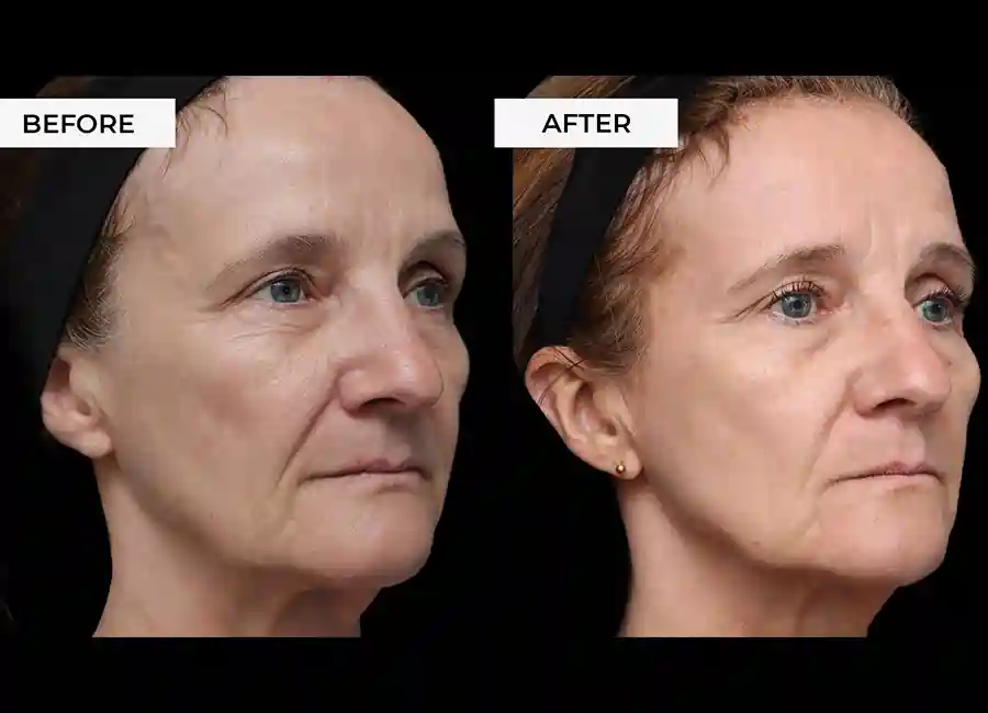 How Many RF Microneedling Sessions Will You Need to See a Difference Bristol?