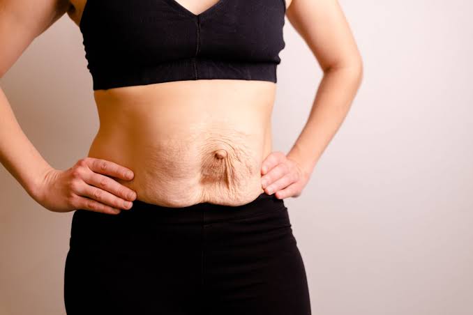 Is Surgery Really the Only Way to Repair Diastasis Recti Bristol?