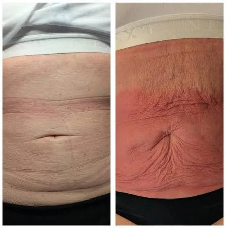 How Does RF Microneedling Improve Crepey, Thin and Uneven Skin Texture Bristol?