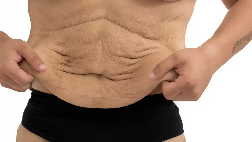 RF Microneedling for Loose Skin: How Can It Help Tighten and Reshape the Skin Bristol?